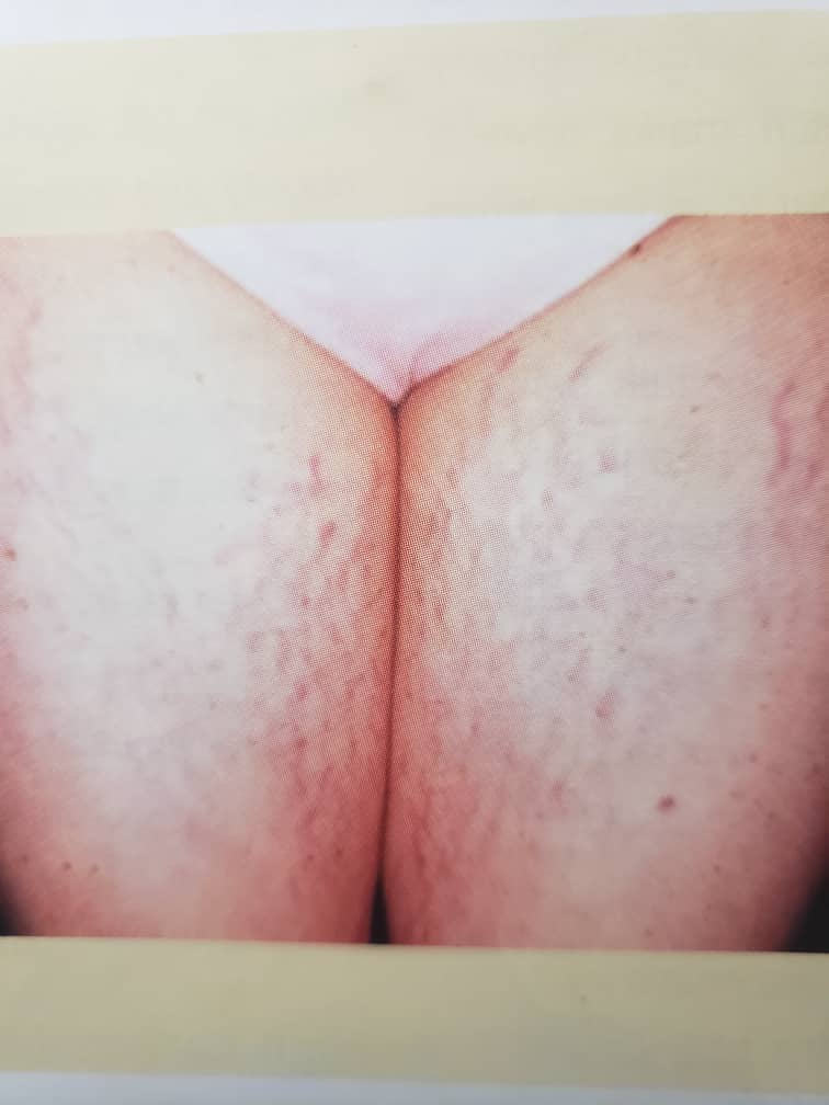 Stretch marks image